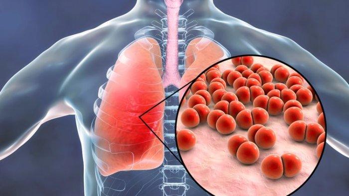 Legionellosis 1892022